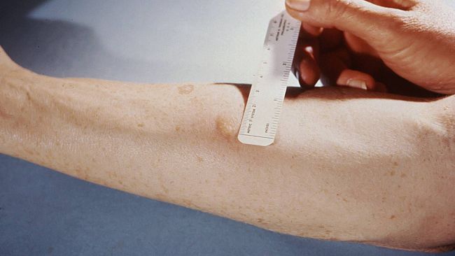 Focolaio di Tubercolosi ad Alcamo. 