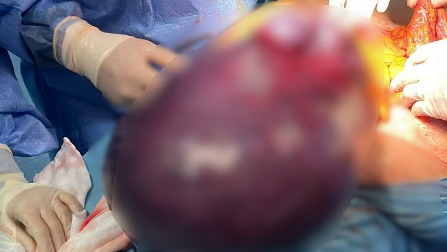 Marsala, ospedale Borsellino, intervento d'urgenza: asportato un fibroma di 16 kg dall'utero di una paziente di 54 anni